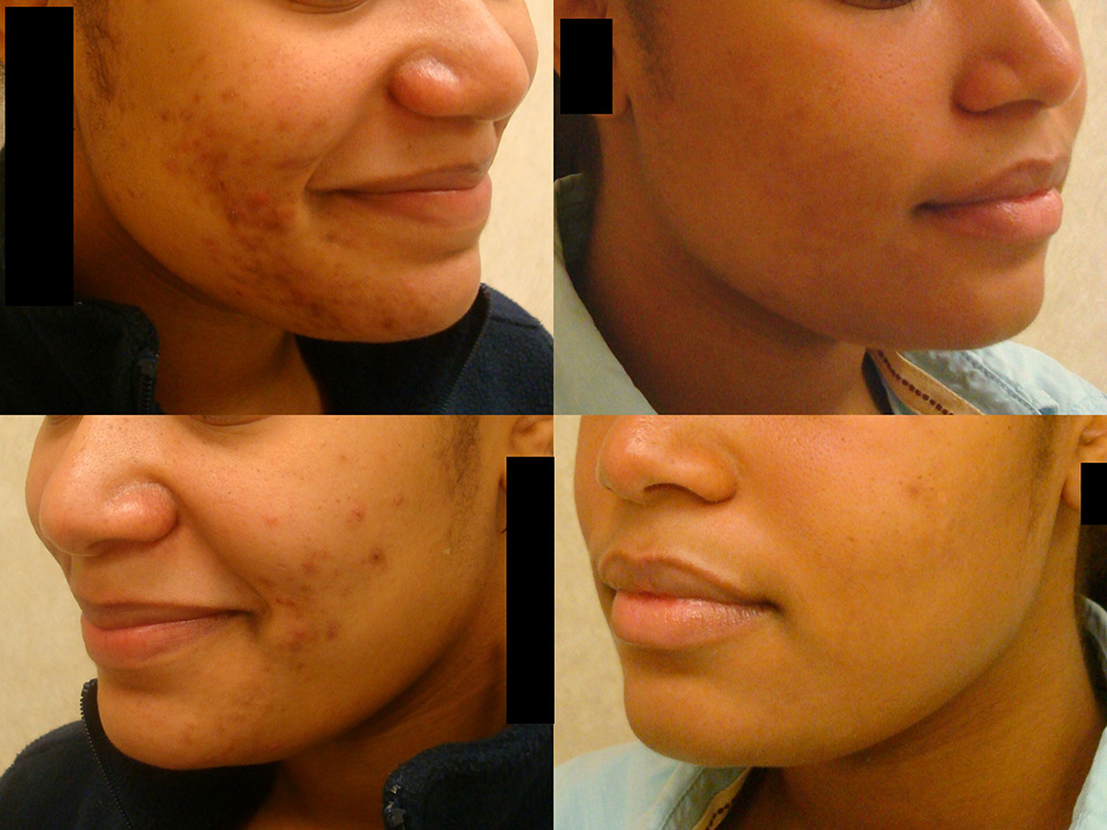 Acne-treatment-2