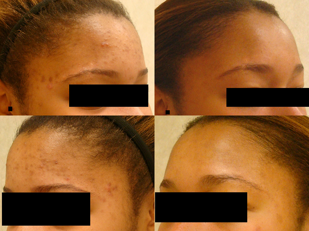 Before:  20 year old female with acne, cysts and blemishes (hyperpigmentation) - 
After: Personalized acne regimen and complexion blending techniques restored the natural beauty of her skin tone and texture