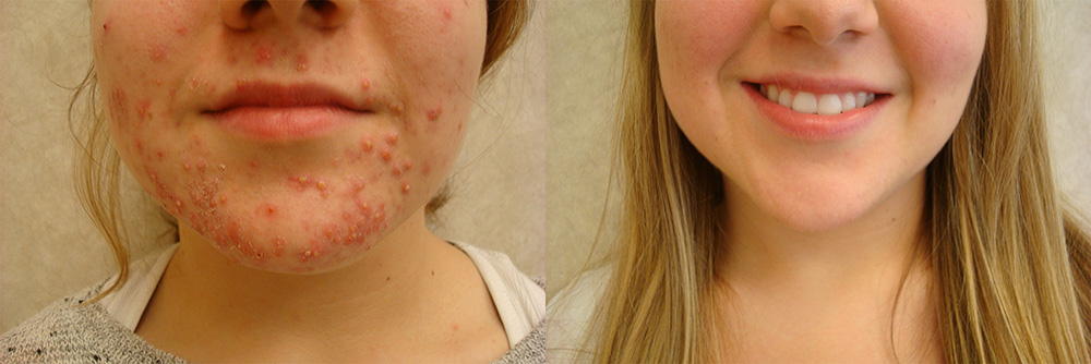 Before: 22 year old female with severe cystic acne recalcitrant to traditional therapies - After: Tailored skin care regimen and combination therapies resulted in a dramatic resolution of her acne