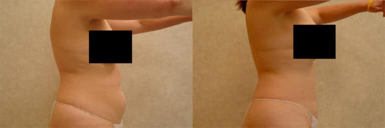 Before: 44 year old female with unwanted abdominal fat After: Laser body sculpting improved abdominal contours