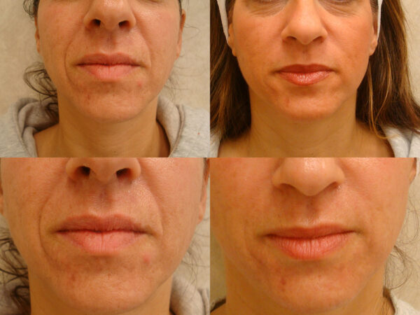 Juvederm Laugh Lines
Before: Deep laugh lines that developed over the course of her lifetime
After: Marked reduction in laugh lines revealing a more youthful appearance