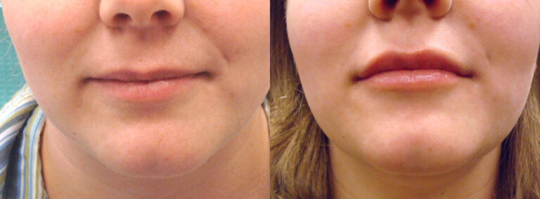 Juvederm Lips
Before: 29 year old female with thin lips
After: Fuller lips accentuating her natural contours