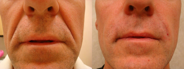 Radiesse - Before: 54 year old male with deep laugh lines
After: Dramatic reduction of the laugh lines resulting in a much younger appearance