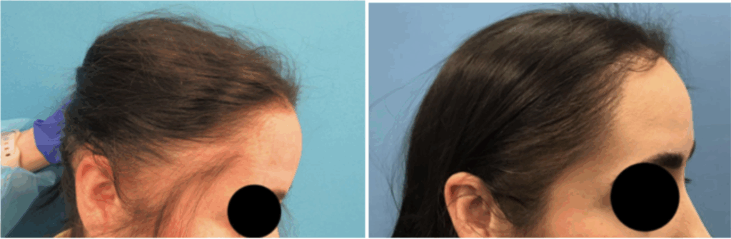 Before and after photo of hair transplantation for women
